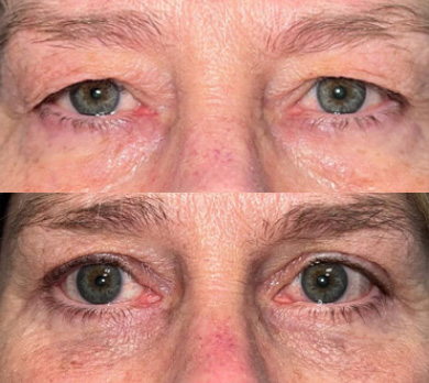 Before and after picture of a male patient undergone upper eyelid surgery