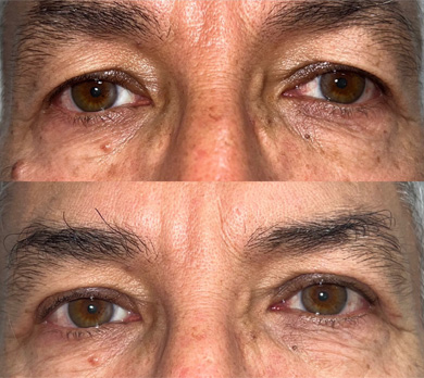 Before and after picture of a patient undergone upper eyelid surgery