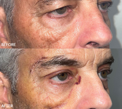 Brow Lift and Blepharoplasty Before and After Image