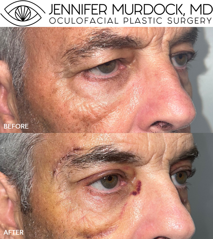 Brow Lift and Blepharoplasty Before and After Image