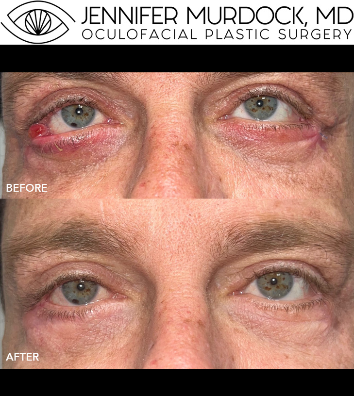 Corrective Eyelid Surgery Before and After Image