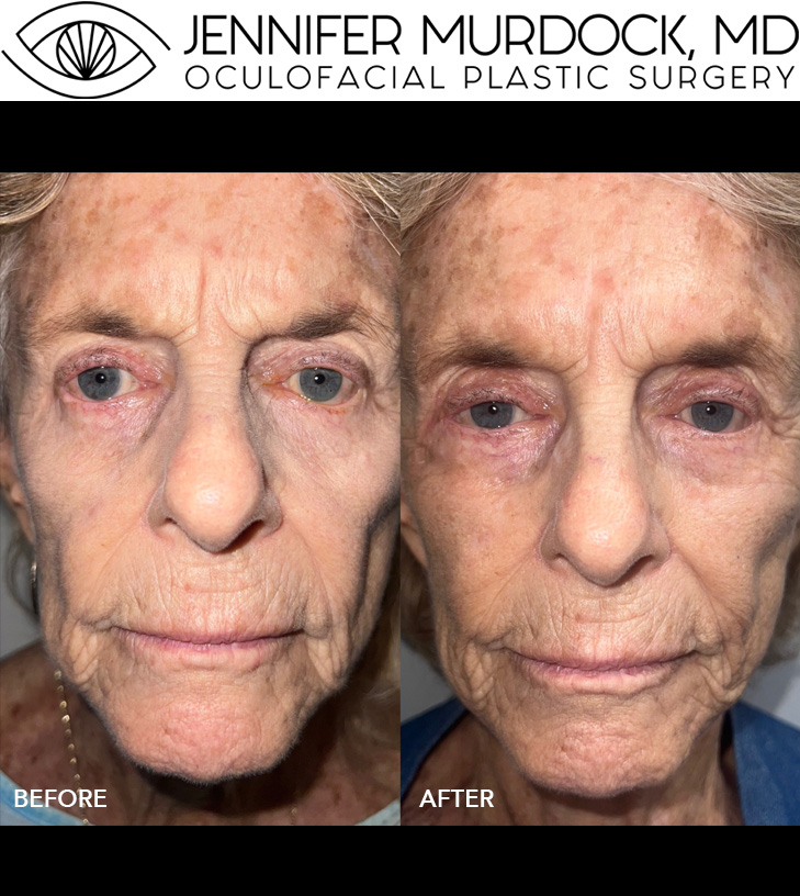 Corrective Eyelid Surgery and Sculptra (Cheeks) Before and After Image