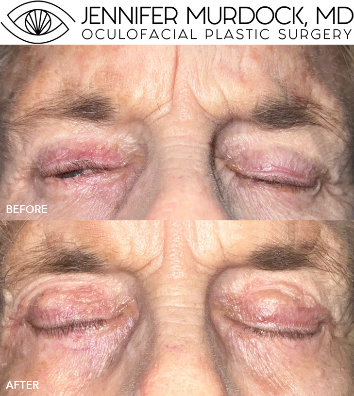 Corrective Eyelid Surgery Before and After Image