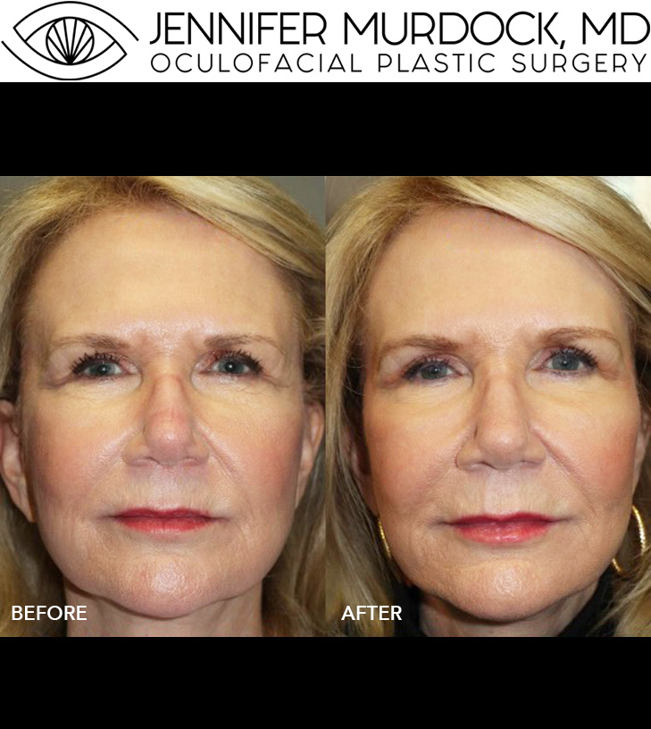 Cosmetic Injection Full Face Before and After Image