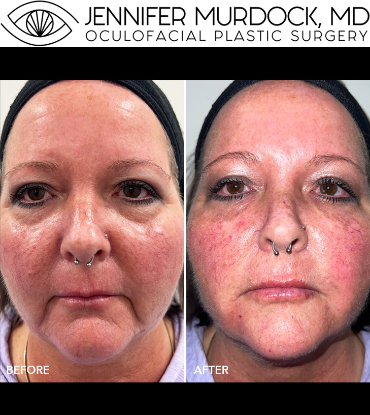 Cosmetic Injection Full Face Before and After Image