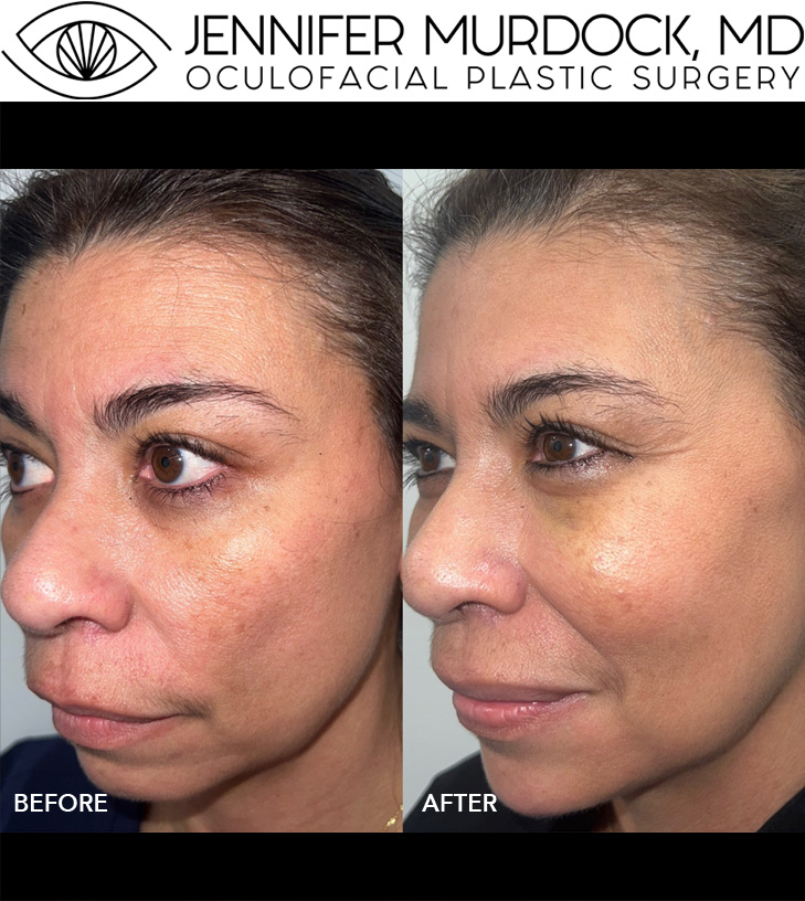 Cosmetic Injection Full Face Before and After Image