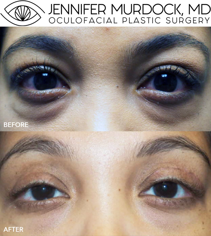 Cosmetic Surgery for Thyroid Eye Disease Before and After Image