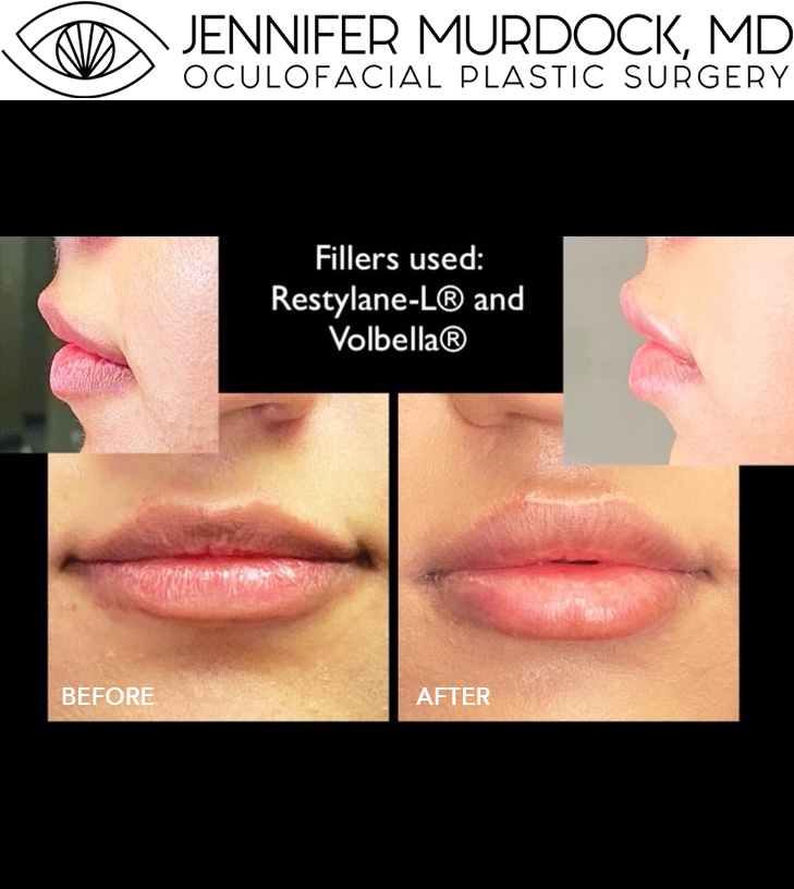 Lip Filler Before and After Image