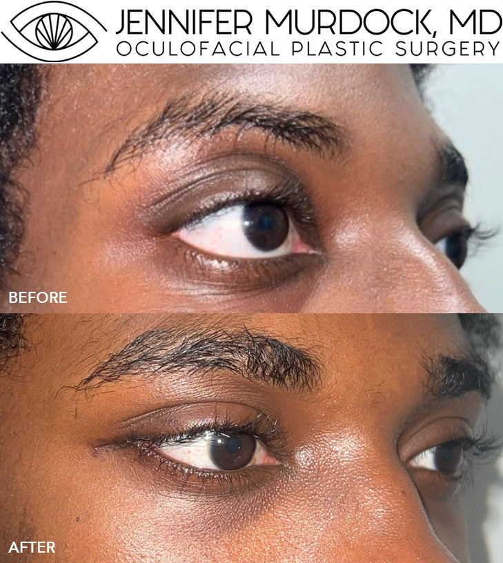 Orbital Decompression Surgery Before and After Image