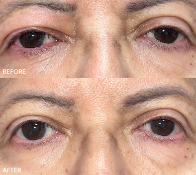 Ptosis Before and After Image