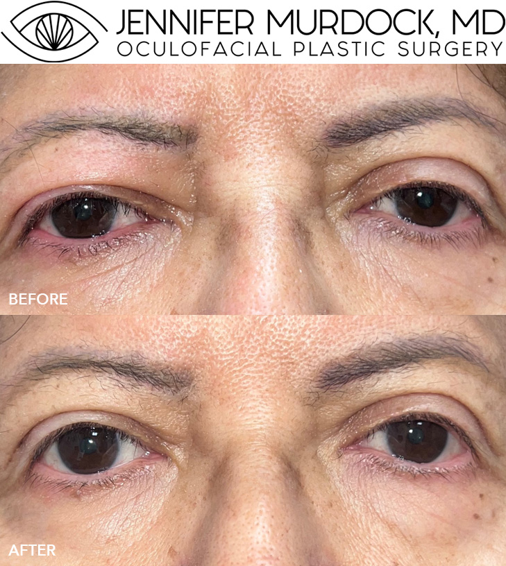 Ptosis Before and After Image