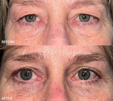 Quad Blepharoplasty Before and After Image