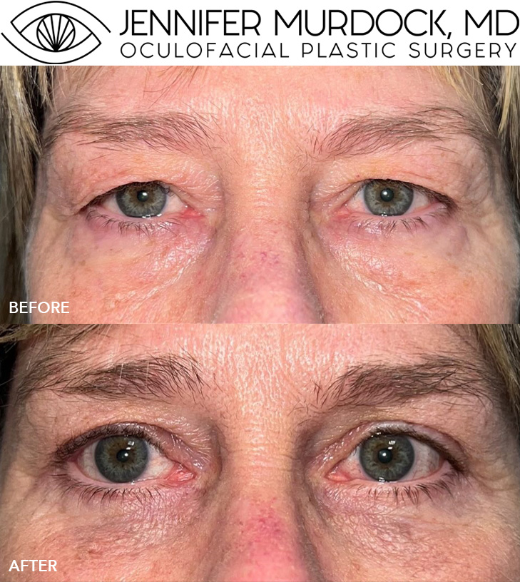 Quad Blepharoplasty Before and After Image