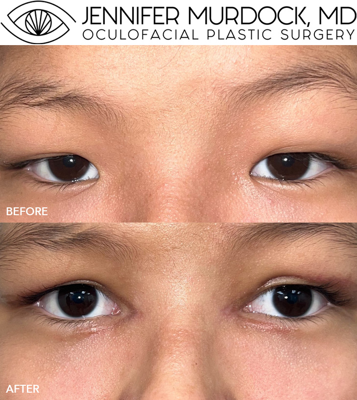 Reconstructive Eyelid Surgery Before and After Image