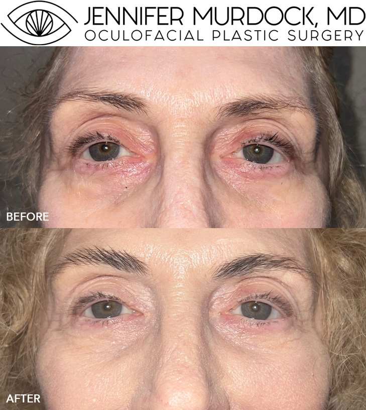 Tear Trough Filler Before and After Image