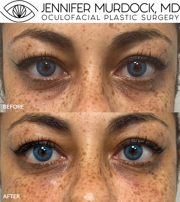 Tear Trough Filler Before and After Image