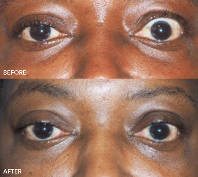 Thyroid Eye Disease Surgery Before and After Image