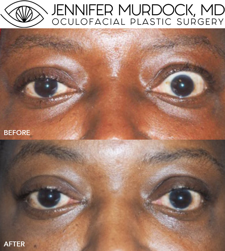 Thyroid Eye Disease Surgery Before and After Image