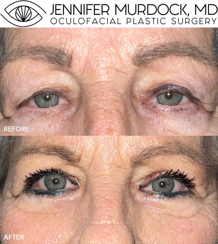 Upper Blepharoplasty Before and After Image