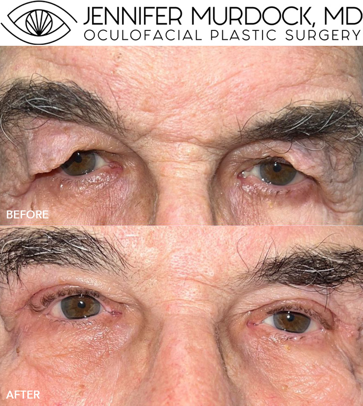 Upper Blepharoplasty Before and After Image