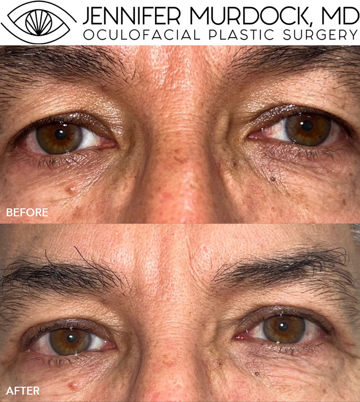 Upper Blepharoplasty Before and After Image