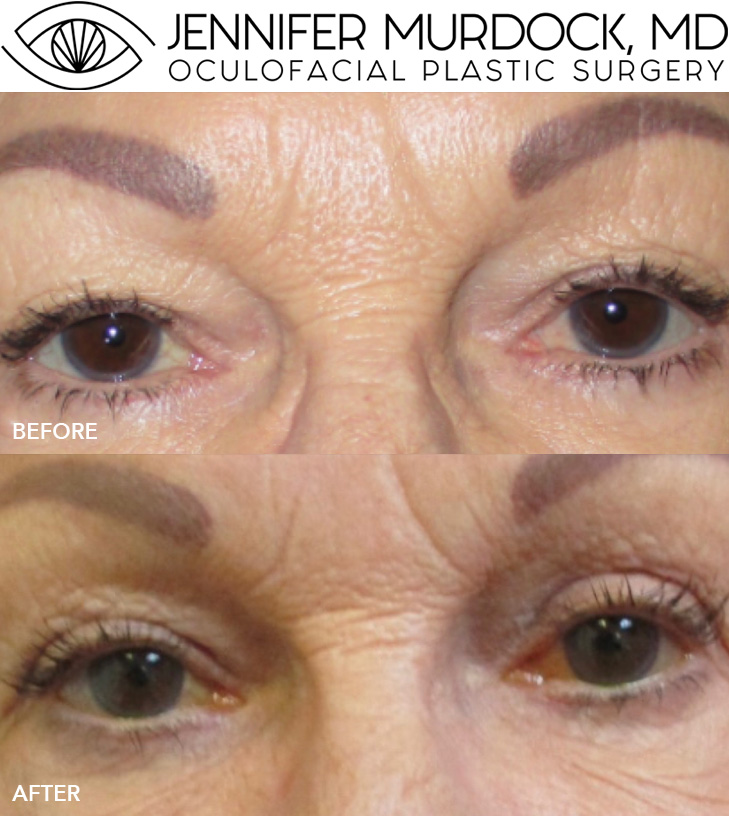 Upper Blepharoplasty Before and After Image