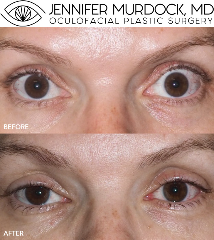 Upper Blepharoplasty Before and After Image