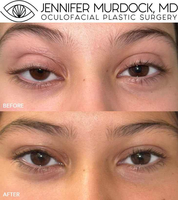 Pediatric Ptosis Repair in Blepharochalasis Pediatric Ptosis Repair in Blepharochalasis
