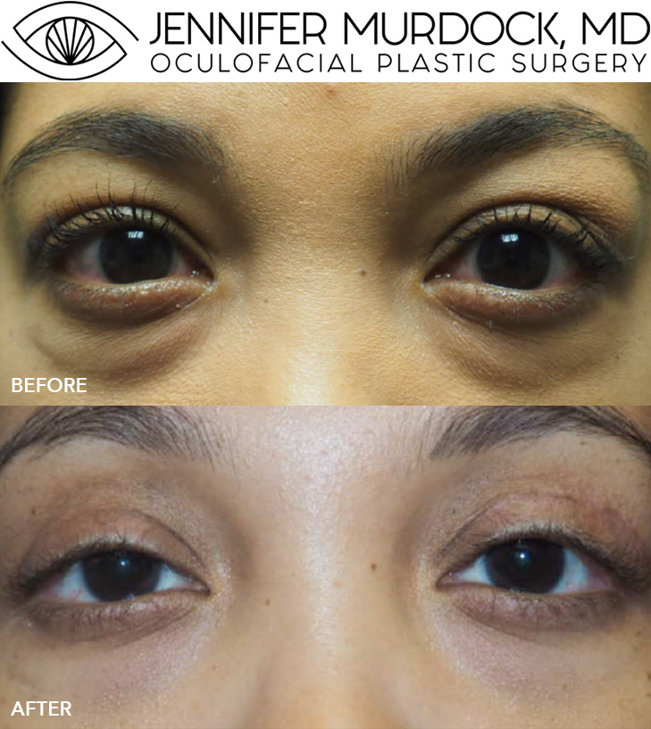 Cosmetic Surgery in Thyroid Eye Disease Cosmetic Surgery in Thyroid Eye Disease