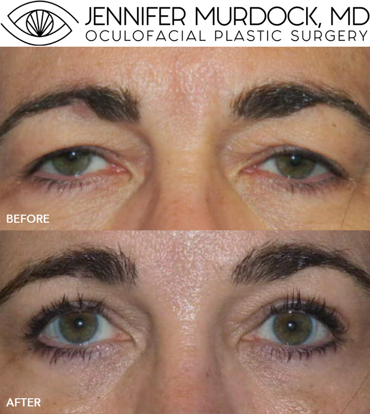 Brow Surgery Patient 1