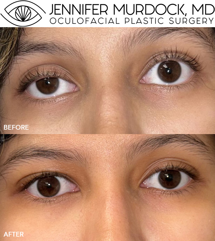 Pediatric Ptosis Pediatric Ptosis
