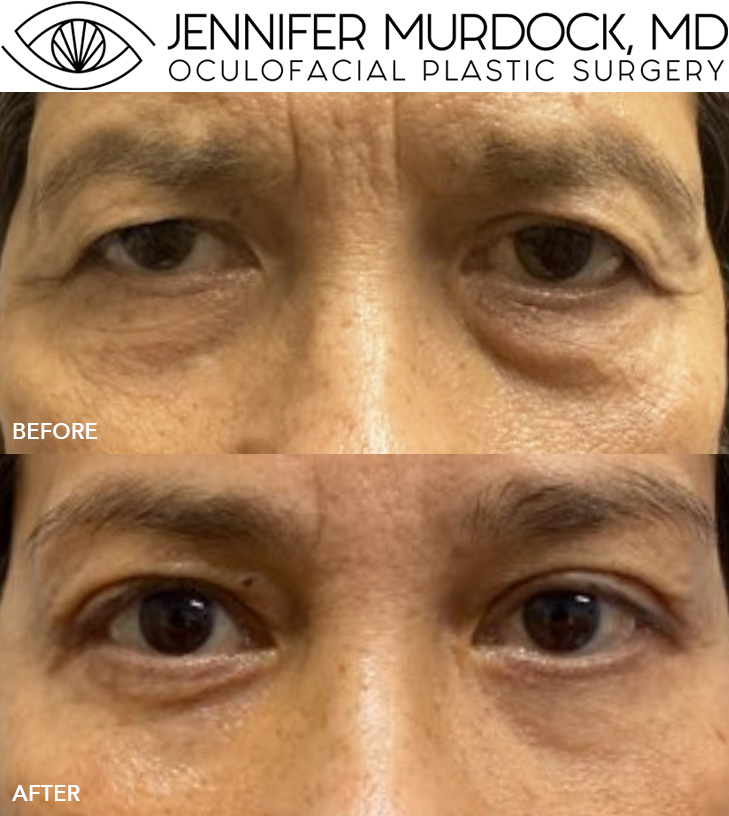 Brow Surgery Patient 2
