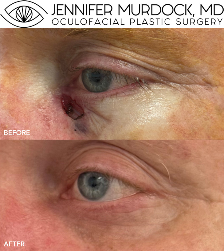 Eyelid Reconstruction Patient 3