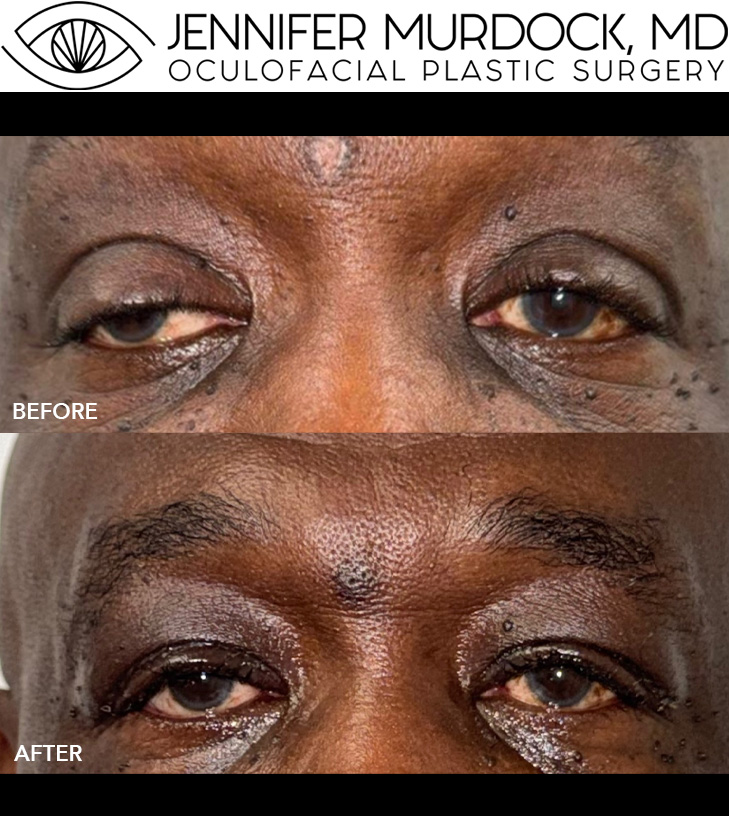 Ptosis Repair Patient 3 Ptosis Repair Patient 3