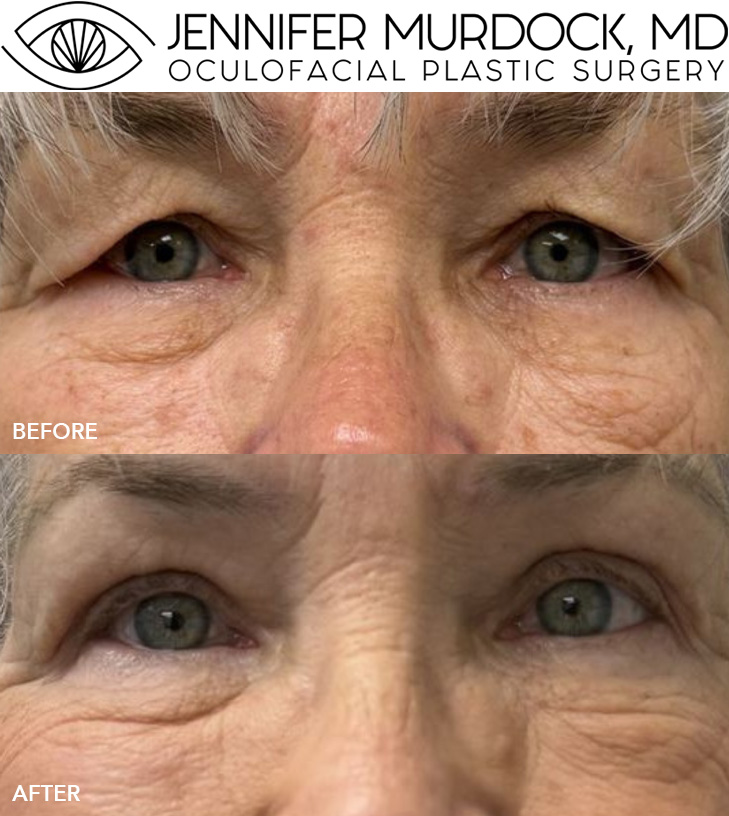 Upper Blepharoplasty Patient 3 Upper Blepharoplasty Patient 3