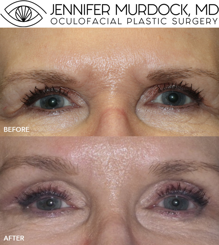Brow Surgery Patient 3