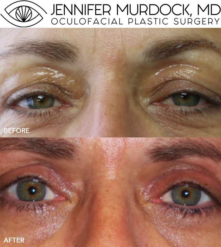 Upper Eyelid External Ptosis Repair and Blepharoplasty Upper Eyelid External Ptosis Repair and Blepharoplasty