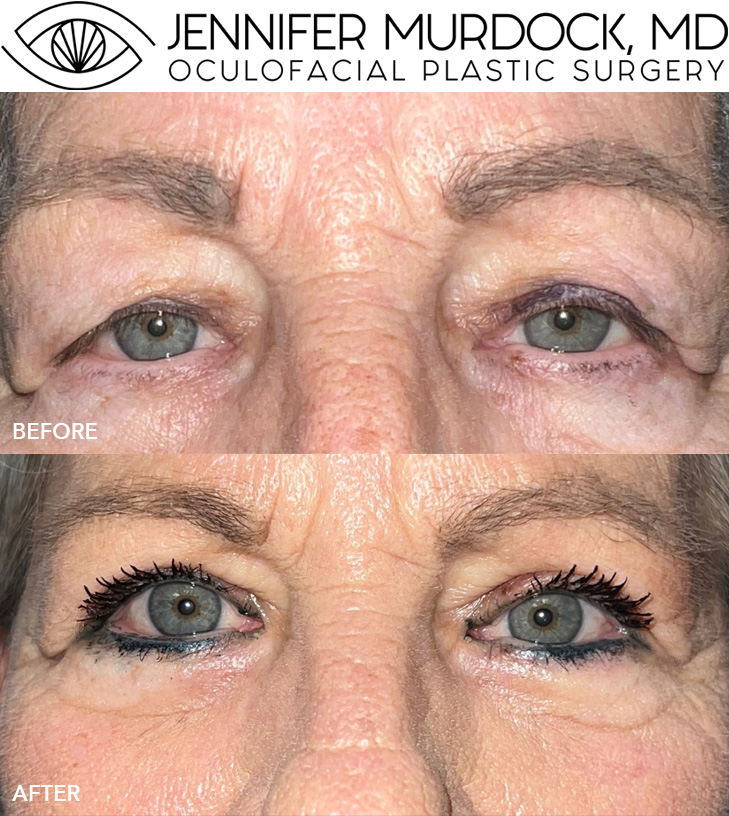 Upper Blepharoplasty Patient 4 Upper Blepharoplasty Patient 4