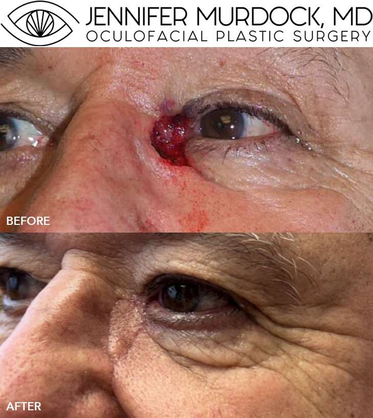 Eyelid Reconstruction Patient 4