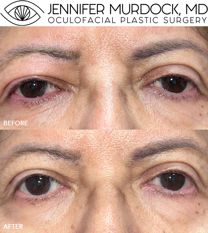 Upper Eyelid Ptosis Repair and Blepharoplasty Upper Eyelid Ptosis Repair and Blepharoplasty