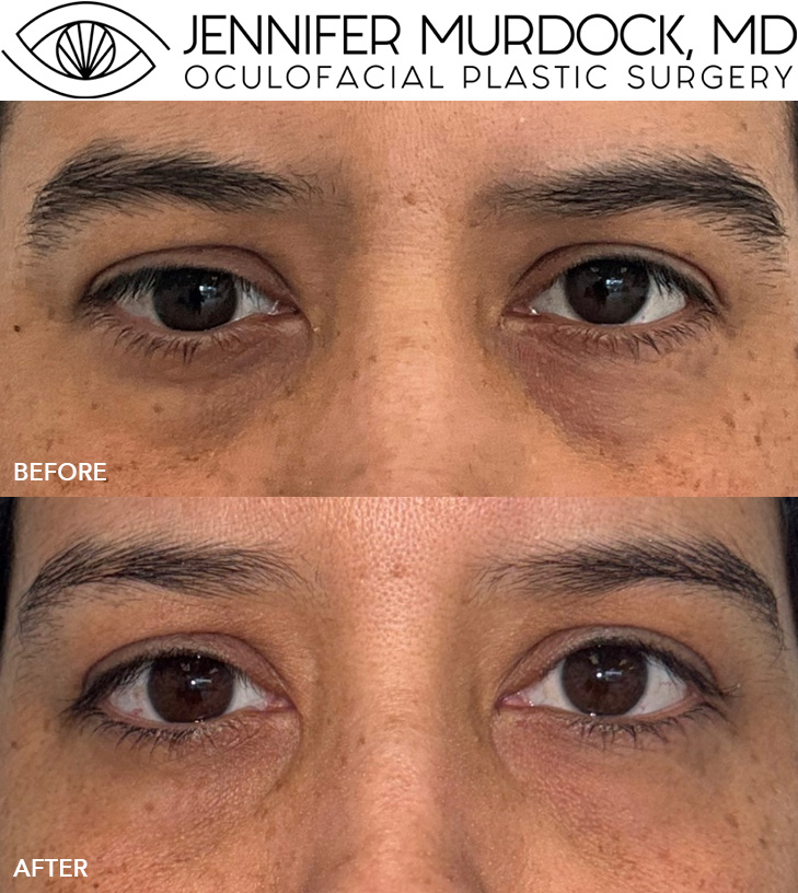 Thyroid Eye Disease Treatment with Tepezza Thyroid Eye Disease Treatment with Tepezza