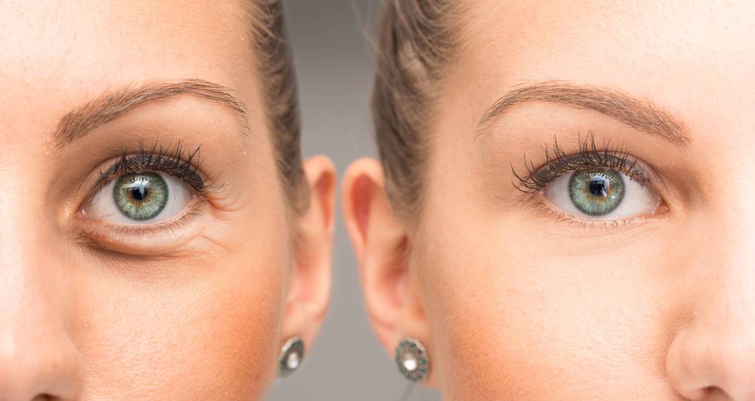 Featured image for How Long Do Eyelid Surgery Results Last