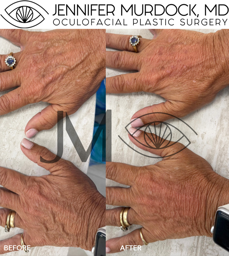 Cosmetic Injections Patient 1 Cosmetic Injections Patient 1