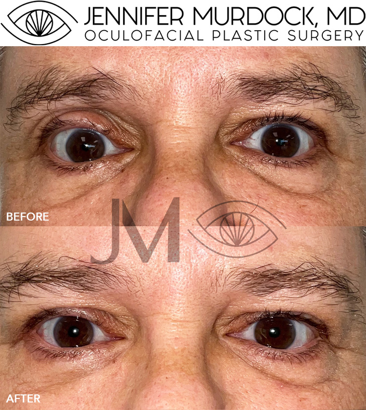 Filler to Correct Asymmetry Filler to Correct Asymmetry