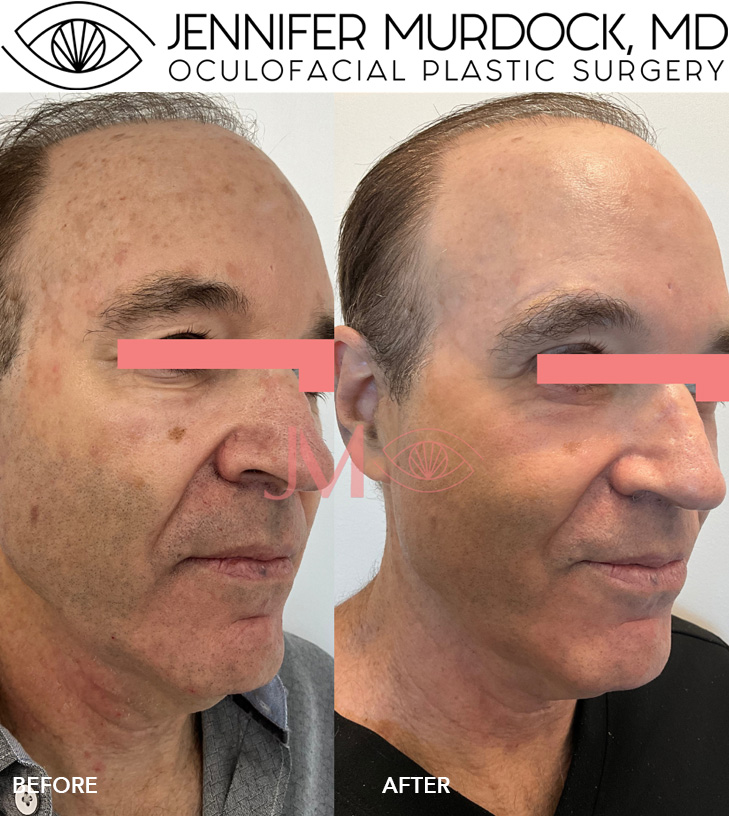 Full Face Laser Resurfacing with Ultra Clear, Baby Blepharoplasty