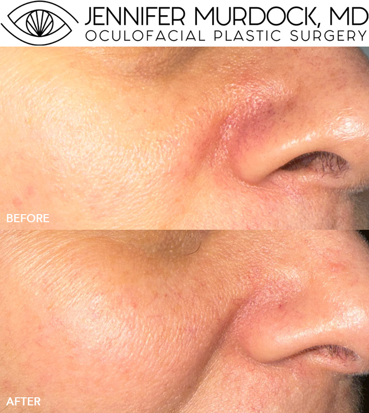 Long Pulsed YAG Laser for Nasal Vessels