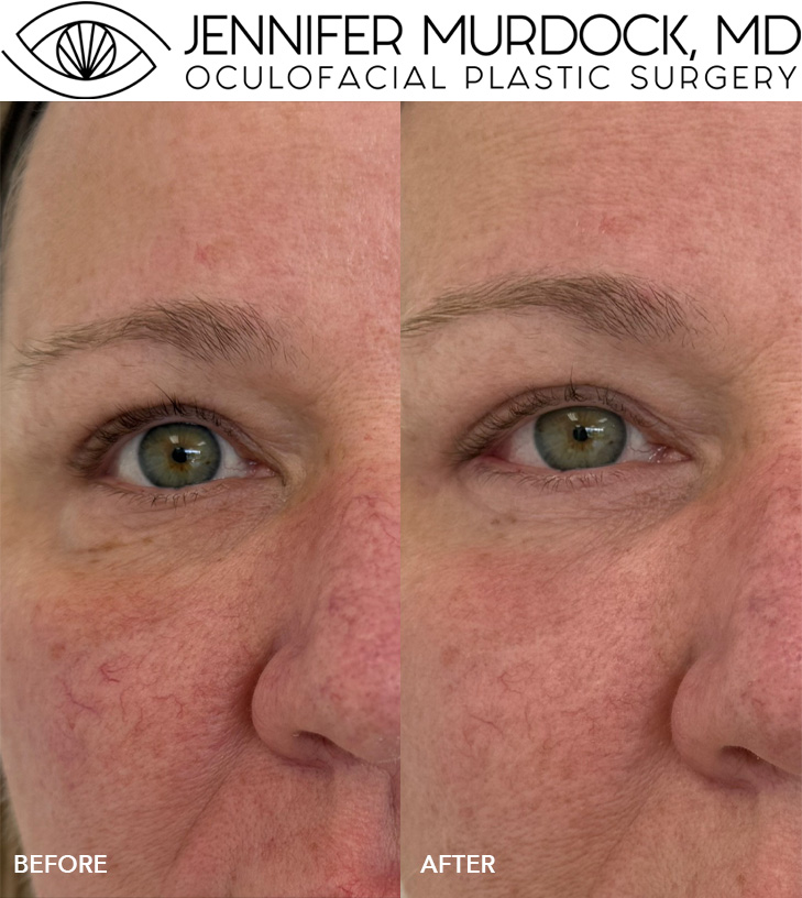 Laser Treatments Patient 3