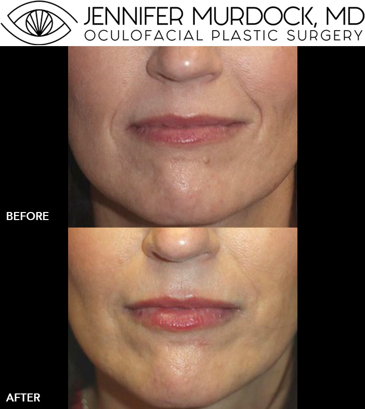 Cosmetic Injections Patient 6 Cosmetic Injections Patient 6