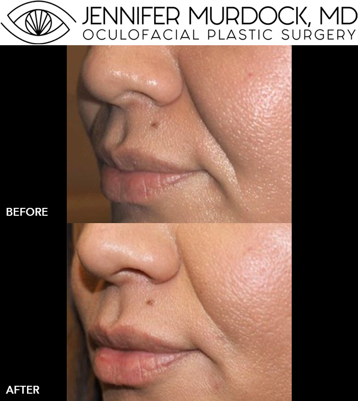 Cosmetic Injections Patient 5 Cosmetic Injections Patient 5