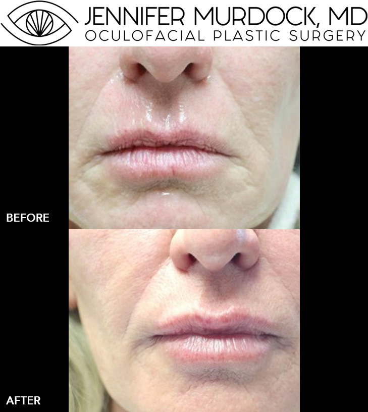 Cosmetic Injections Patient 7 Cosmetic Injections Patient 7